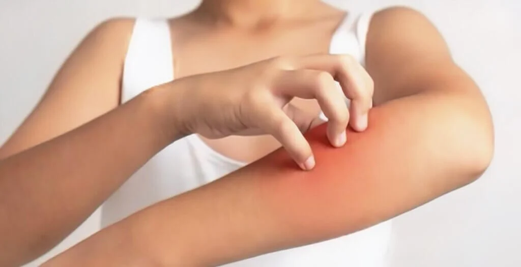 Skin Rashes and Eczema Treatment in Apollo Beach, FL – Fast Track Urgent Care